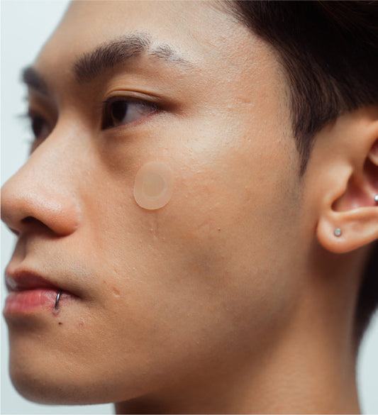 Why Your Acne Keeps Coming Back — And How to Break the Loop